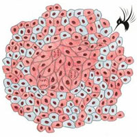肿瘤标志物之CA-153临床意义