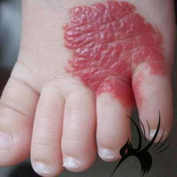 血管瘤的微创硬化治疗