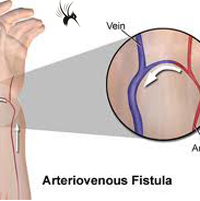自体动静脉内瘘流量预判