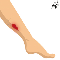 慢性下肢溃疡抗感染方案